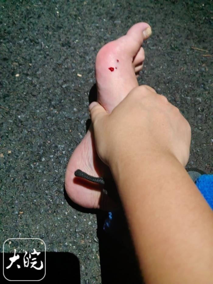 意大利甲组联赛_合肥一市民夜爬大蜀山被毒蛇咬伤 公园管理处呼吁:尽量避免夜间登山