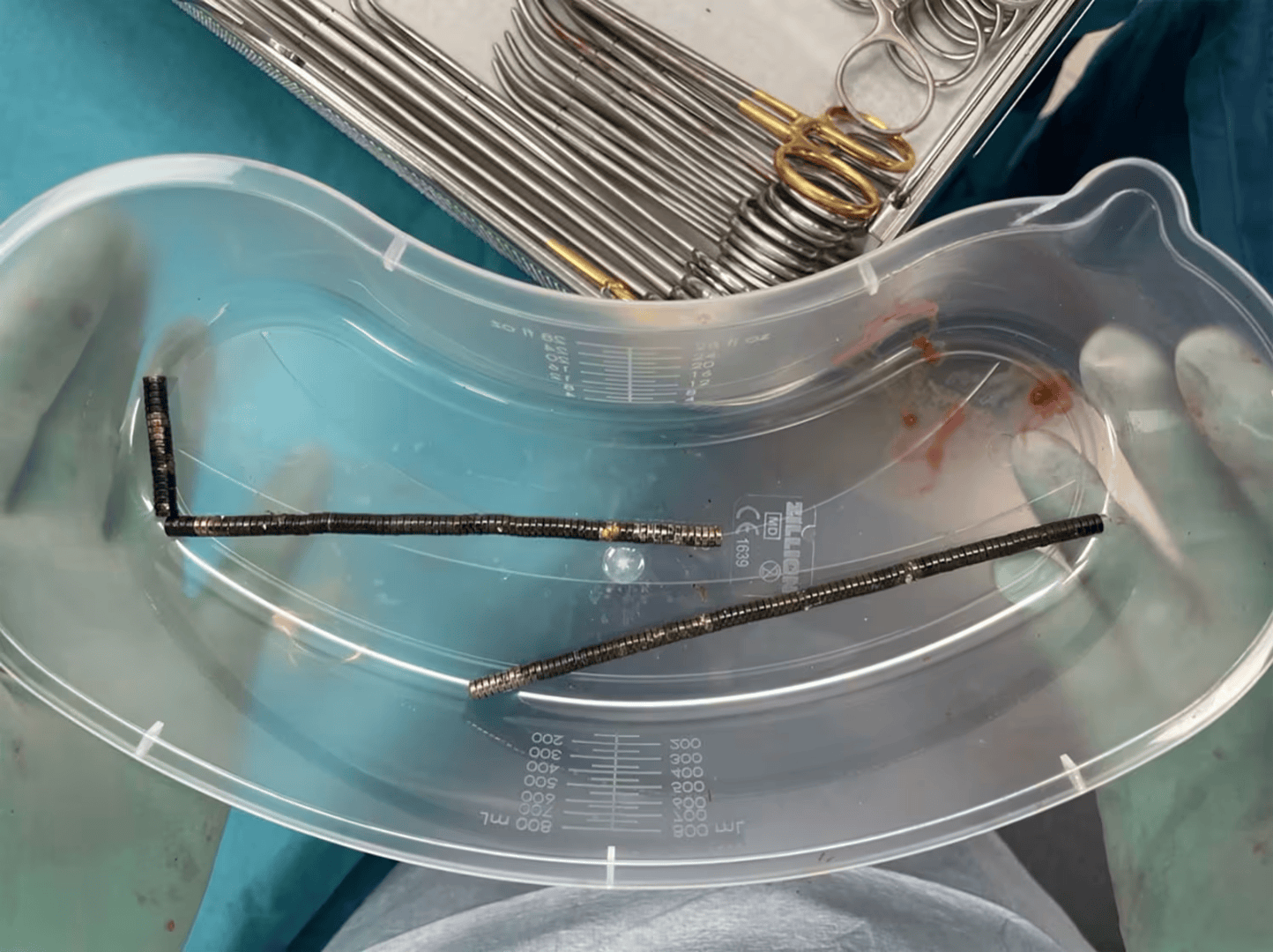 皇冠信用網出租代理_腹痛4天后送医皇冠信用網出租代理，新西兰男孩吞下约100颗磁铁致肠道坏死 医生切除部分肠组织