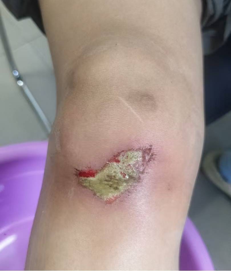 皇冠体育网
_杭州35岁女子环洱海骑行时摔破皮皇冠体育网
,用自来水冲了冲伤口,回家后高烧近40℃,紧急送医
